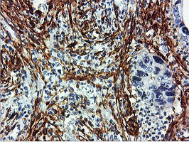 TAGLN / Transgelin / SM22 Antibody - IHC of paraffin-embedded Carcinoma of Human pancreas tissue using anti-TAGLN mouse monoclonal antibody.