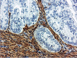 TAGLN / Transgelin / SM22 Antibody - IHC of paraffin-embedded Adenocarcinoma of Human endometrium tissue using anti-TAGLN mouse monoclonal antibody.