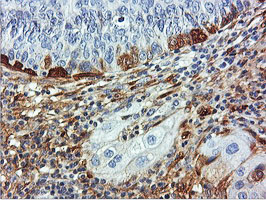 TAGLN / Transgelin / SM22 Antibody - IHC of paraffin-embedded Carcinoma of Human bladder tissue using anti-TAGLN mouse monoclonal antibody.