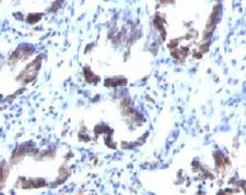 TAGLN / Transgelin / SM22 Antibody - IHC testing of FFPE human colon carcinoma with SM22 alpha antibody (clone SMP22a).  This image was taken for the unmodified form of this product. Other forms have not been tested.