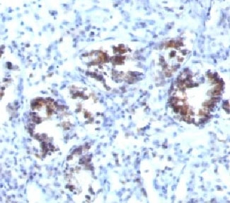 TAGLN / Transgelin / SM22 Antibody - Formalin-fixed, paraffin-embedded human colon carcinoma stained with Transgelin antibody (SPM606).  This image was taken for the unmodified form of this product. Other forms have not been tested.
