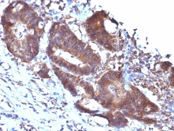 TAGLN / Transgelin / SM22 Antibody - Formalin-fixed, paraffin-embedded human colon carcinoma stained with SM22 antibody (TAGLN/247).  This image was taken for the unmodified form of this product. Other forms have not been tested.