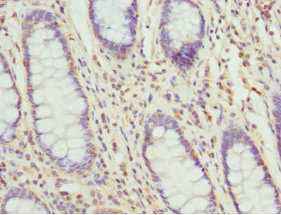 TAGLN2 / Transgelin 2 Antibody - Immunohistochemistry of paraffin-embedded human colon cancer tissue at dilution 1:100