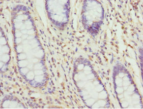TAGLN2 / Transgelin 2 Antibody - Immunohistochemistry of paraffin-embedded human colon cancer using TAGLN2 Antibody at dilution of 1:100