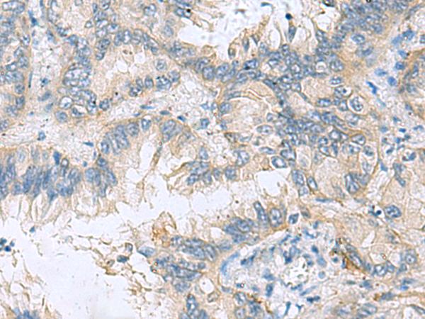 TAGLN3 / Neuronal Protein 22 Antibody - Immunohistochemistry of paraffin-embedded Human lung cancer tissue  using TAGLN3 Polyclonal Antibody at dilution of 1:70(×200)