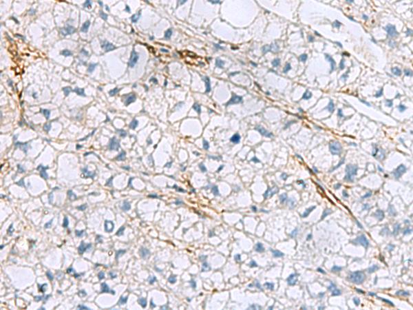 TAGLN3 / Neuronal Protein 22 Antibody - Immunohistochemistry of paraffin-embedded Human liver cancer tissue  using TAGLN3 Polyclonal Antibody at dilution of 1:60(×200)