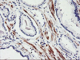 TAL1 Antibody - IHC of paraffin-embedded Carcinoma of Human prostate tissue using anti-TAL1 mouse monoclonal antibody.