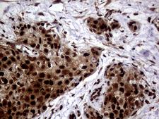 TALDO1 / Transaldolase 1 Antibody - Immunohistochemical staining of paraffin-embedded Carcinoma of Human bladder tissue using anti-TALDO1 mouse monoclonal antibody. (Heat-induced epitope retrieval by 1mM EDTA in 10mM Tris buffer. (pH8.5) at 120°C for 3 min. (1:500)