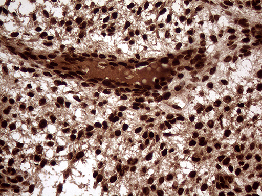 TALDO1 / Transaldolase 1 Antibody - Immunohistochemical staining of paraffin-embedded Human endometrium tissue within the normal limits using anti-TALDO1 mouse monoclonal antibody. (Heat-induced epitope retrieval by 1mM EDTA in 10mM Tris buffer. (pH8.5) at 120°C for 3 min. (1:500)