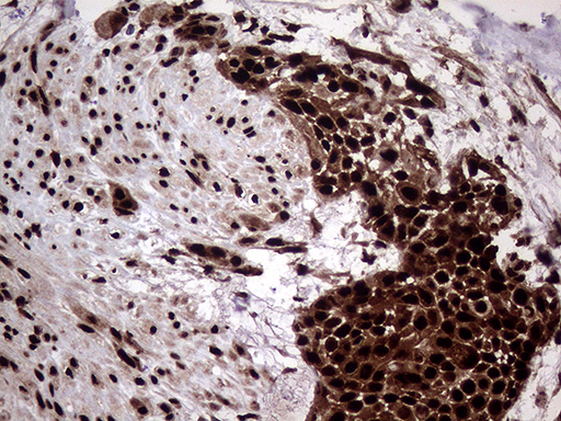 TALDO1 / Transaldolase 1 Antibody - Immunohistochemical staining of paraffin-embedded Carcinoma of Human bladder tissue using anti-TALDO1 mouse monoclonal antibody. (Heat-induced epitope retrieval by 1mM EDTA in 10mM Tris buffer. (pH8.5) at 120°C for 3 min. (1:500)