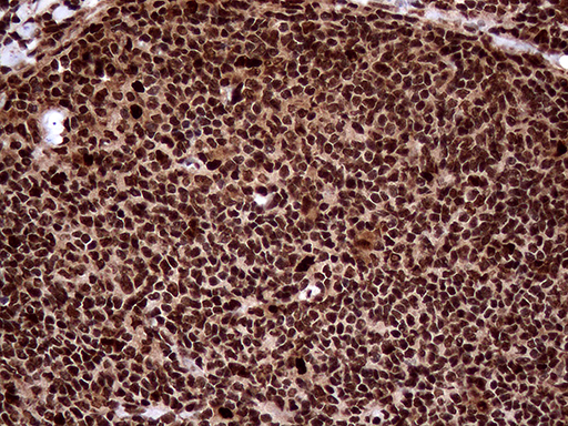TALDO1 / Transaldolase 1 Antibody - Immunohistochemical staining of paraffin-embedded Human lymphoma tissue using anti-TALDO1 mouse monoclonal antibody. (Heat-induced epitope retrieval by 1mM EDTA in 10mM Tris buffer. (pH8.5) at 120°C for 3 min. (1:500)