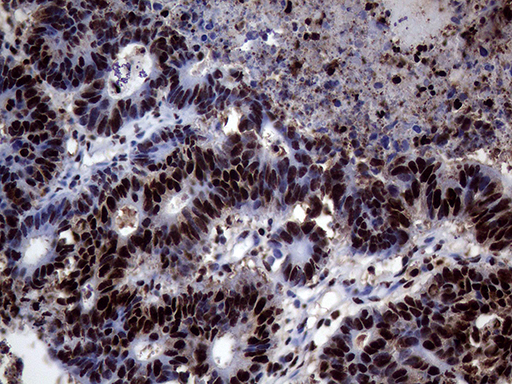 TALDO1 / Transaldolase 1 Antibody - Immunohistochemical staining of paraffin-embedded Adenocarcinoma of Human colon tissue using anti-TALDO1 mouse monoclonal antibody. (Heat-induced epitope retrieval by 1mM EDTA in 10mM Tris buffer. (pH8.5) at 120°C for 3 min. (1:500)