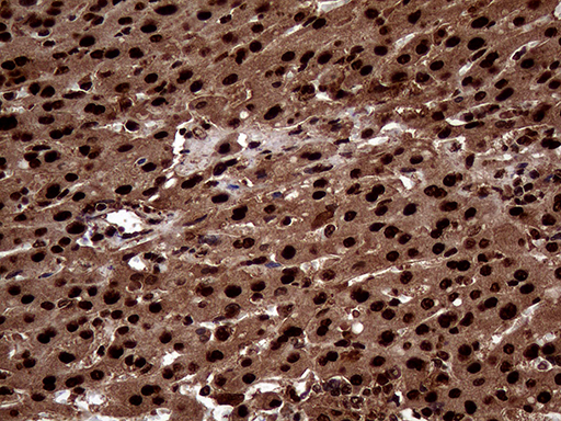 TALDO1 / Transaldolase 1 Antibody - Immunohistochemical staining of paraffin-embedded Carcinoma of Human liver tissue using anti-TALDO1 mouse monoclonal antibody. (Heat-induced epitope retrieval by 1mM EDTA in 10mM Tris buffer. (pH8.5) at 120°C for 3 min. (1:500)