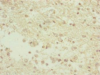 TAMM41 / C3orf31 Antibody - Immunohistochemistry of paraffin-embedded human glioma cancer at dilution of 1:100