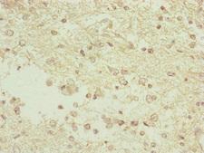 TAMM41 / C3orf31 Antibody - Immunohistochemistry of paraffin-embedded human glioma cancer at dilution of 1:100