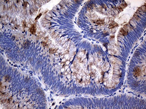 TANK Antibody - Immunohistochemical staining of paraffin-embedded Adenocarcinoma of Human colon tissue using anti-TANK mouse monoclonal antibody. (Heat-induced epitope retrieval by 1mM EDTA in 10mM Tris buffer. (pH8.5) at 120°C for 3 min. (1:500)