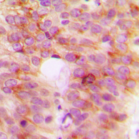 TANK Antibody - Immunohistochemical analysis of TANK staining in human breast cancer formalin fixed paraffin embedded tissue section. The section was pre-treated using heat mediated antigen retrieval with sodium citrate buffer (pH 6.0). The section was then incubated with the antibody at room temperature and detected using an HRP conjugated compact polymer system. DAB was used as the chromogen. The section was then counterstained with hematoxylin and mounted with DPX.