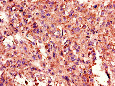 TANK Antibody - Immunohistochemistry of paraffin-embedded human melanoma cancer using TANK Antibody at dilution of 1:100