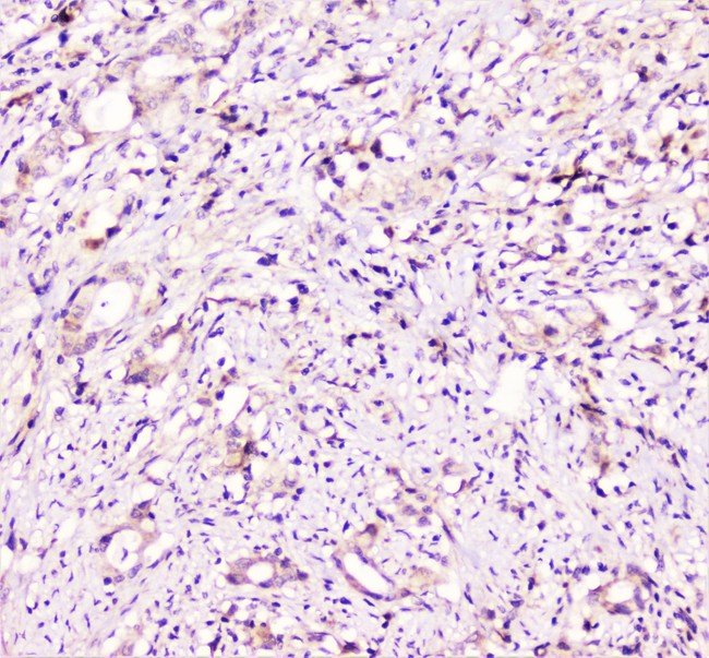 TANK Antibody - IHC analysis of TANK using anti-TANK antibody. TANK was detected in paraffin-embedded section of human rectal cancer tissue. Heat mediated antigen retrieval was performed in citrate buffer (pH6, epitope retrieval solution) for 20 mins. The tissue section was blocked with 10% goat serum. The tissue section was then incubated with 1µg/ml rabbit anti-TANK Antibody overnight at 4°C. Biotinylated goat anti-rabbit IgG was used as secondary antibody and incubated for 30 minutes at 37°C. The tissue section was developed using Strepavidin-Biotin-Complex (SABC) with DAB as the chromogen.