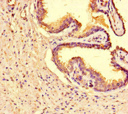 TANK2 / TNKS2 Antibody - Immunohistochemistry of paraffin-embedded human prostate cancer at dilution of 1:100