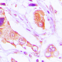 TAOK1 / TAO1 Antibody - Immunohistochemical analysis of TAO1 staining in human lung cancer formalin fixed paraffin embedded tissue section. The section was pre-treated using heat mediated antigen retrieval with sodium citrate buffer (pH 6.0). The section was then incubated with the antibody at room temperature and detected using an HRP conjugated compact polymer system. DAB was used as the chromogen. The section was then counterstained with hematoxylin and mounted with DPX.