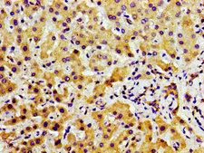 TAOK2 / TAO2 Antibody - Immunohistochemistry image of paraffin-embedded human liver cancer at a dilution of 1:100