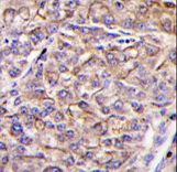 TAOK3 / JIK Antibody - Formalin-fixed and paraffin-embedded human hepatocarcinoma tissue reacted with TAOK3 antibody , which was peroxidase-conjugated to the secondary antibody, followed by DAB staining. This data demonstrates the use of this antibody for immunohistochemistry; clinical relevance has not been evaluated.