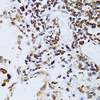 TAPBP / Tapasin Antibody - Immunohistochemistry of paraffin-embedded human lung cancer using TAPBP antibody at dilution of 1:100 (40x lens).