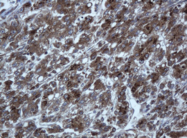 TAPBPL / TAPBPR Antibody - IHC of paraffin-embedded Carcinoma of Human liver tissue using anti-TAPBPL mouse monoclonal antibody.