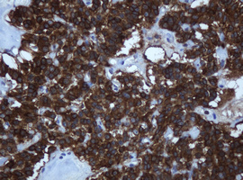 TAPBPL / TAPBPR Antibody - IHC of paraffin-embedded Carcinoma of Human pancreas tissue using anti-TAPBPL mouse monoclonal antibody.