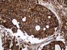 TAPBPL / TAPBPR Antibody - IHC of paraffin-embedded Adenocarcinoma of Human breast tissue using anti-TAPBPL mouse monoclonal antibody.