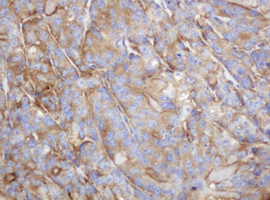 TAPBPL / TAPBPR Antibody - IHC of paraffin-embedded Adenocarcinoma of Human colon tissue using anti-TAPBPL mouse monoclonal antibody.