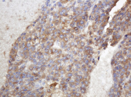 TAPBPL / TAPBPR Antibody - IHC of paraffin-embedded Carcinoma of Human liver tissue using anti-TAPBPL mouse monoclonal antibody.