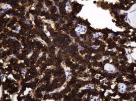 TAPBPL / TAPBPR Antibody - IHC of paraffin-embedded Carcinoma of Human pancreas tissue using anti-TAPBPL mouse monoclonal antibody.