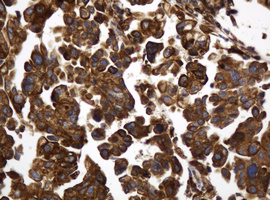 TAPBPL / TAPBPR Antibody - IHC of paraffin-embedded Carcinoma of Human bladder tissue using anti-TAPBPL mouse monoclonal antibody.