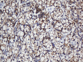 TAPBPL / TAPBPR Antibody - IHC of paraffin-embedded Carcinoma of Human kidney tissue using anti-TAPBPL mouse monoclonal antibody.