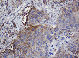 TAPBPL / TAPBPR Antibody - IHC of paraffin-embedded Carcinoma of Human lung tissue using anti-TAPBPL mouse monoclonal antibody.