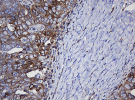 TAPBPL / TAPBPR Antibody - IHC of paraffin-embedded Adenocarcinoma of Human ovary tissue using anti-TAPBPL mouse monoclonal antibody.