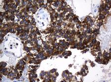 TAPBPL / TAPBPR Antibody - IHC of paraffin-embedded Carcinoma of Human pancreas tissue using anti-TAPBPL mouse monoclonal antibody. (Heat-induced epitope retrieval by 10mM citric buffer, pH6.0, 120°C for 3min).