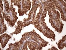 TARBP2 / TRBP2 Antibody - Immunohistochemical staining of paraffin-embedded Carcinoma of Human thyroid tissue using anti-TARBP2 mouse monoclonal antibody. (Heat-induced epitope retrieval by 1mM EDTA in 10mM Tris buffer. (pH8.5) at 120 oC for 3 min. (1:150)