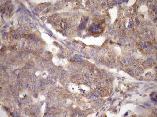 TARBP2 / TRBP2 Antibody - Immunohistochemical staining of paraffin-embedded Carcinoma of Human kidney tissue using anti-TARBP2 mouse monoclonal antibody. (Heat-induced epitope retrieval by Tris-EDTA, pH8.0)(1:150)