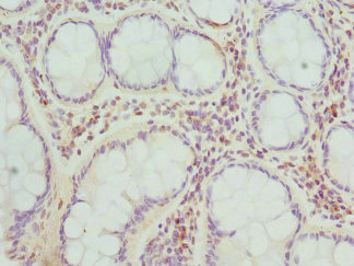 TARS Antibody - Immunohistochemistry of paraffin-embedded human colon cancer at dilution 1:100