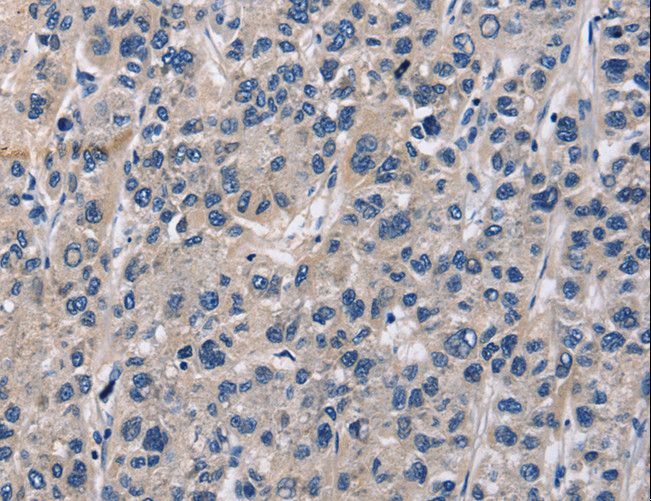TARSH / ABI3BP Antibody - Immunohistochemistry of paraffin-embedded Human liver cancer using ABI3BP Polyclonal Antibody at dilution of 1:60.