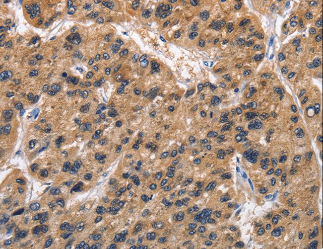 TARSH / ABI3BP Antibody - Immunohistochemistry of paraffin-embedded Human prostate cancer using ABI3BP Polyclonal Antibody at dilution of 1:50.