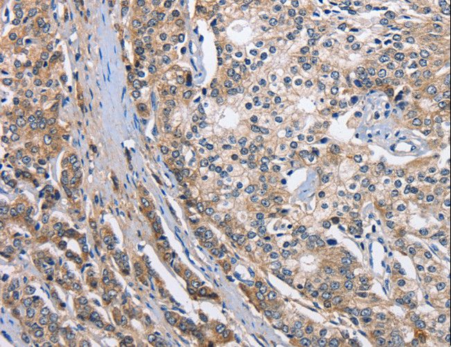 TARSH / ABI3BP Antibody - Immunohistochemistry of paraffin-embedded Human prostate cancer using ABI3BP Polyclonal Antibody at dilution of 1:50.