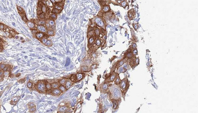 TAS2R38 Antibody - 1:100 staining human Head and neck carcinoma tissue by IHC-P. The sample was formaldehyde fixed and a heat mediated antigen retrieval step in citrate buffer was performed. The sample was then blocked and incubated with the antibody for 1.5 hours at 22°C. An HRP conjugated goat anti-rabbit antibody was used as the secondary.