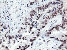TASP / LANCL2 Antibody - IHC of paraffin-embedded Adenocarcinoma of Human ovary tissue using anti-LANCL2 mouse monoclonal antibody. (Heat-induced epitope retrieval by 10mM citric buffer, pH6.0, 100C for 10min).