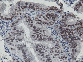 TASP / LANCL2 Antibody - IHC of paraffin-embedded Adenocarcinoma of Human endometrium tissue using anti-LANCL2 mouse monoclonal antibody. (Heat-induced epitope retrieval by 10mM citric buffer, pH6.0, 100C for 10min).