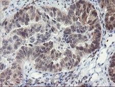 TASP / LANCL2 Antibody - IHC of paraffin-embedded Adenocarcinoma of Human ovary tissue using anti-LANCL2 mouse monoclonal antibody.