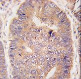 TASP1 Antibody - Formalin-fixed and paraffin-embedded human colon carcinoma tissue reacted with hTASP1-C-term , which was peroxidase-conjugated to the secondary antibody, followed by DAB staining. This data demonstrates the use of this antibody for immunohistochemistry; clinical relevance has not been evaluated.
